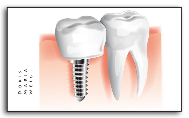 Zahnimplantat - Vektorgrafik - Illustrationen Doris Maria Weigl / Medizin