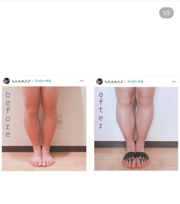 足先サポーター(外反母趾、モートン病、O脚、腰痛、膝痛 足先サポーター(外反母趾、モートン病、O脚、腰痛、膝痛