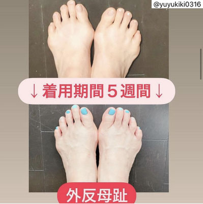 足先サポーター(外反母趾、モートン病、O脚、腰痛、膝痛 足先サポーター(外反母趾、モートン病、O脚、腰痛、膝痛