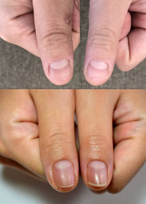 深爪ネイル,深爪治す,深爪治せるサロン,深爪治療,深爪矯正