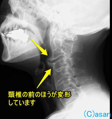 頸椎の変形による喉の異常感