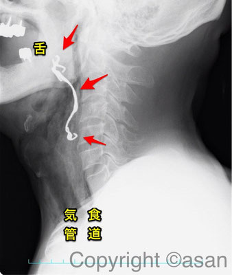 長い足（リンガルバー）が下に向いて食道にはまっています