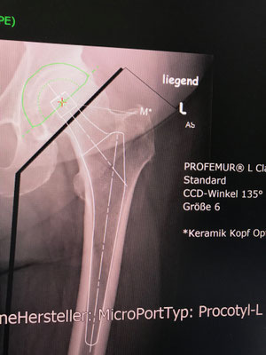 Computer Planung und Ausmessung vor der OP