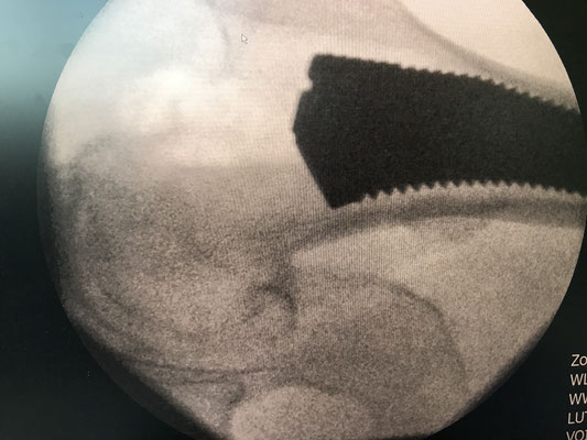 Superpath Hüft - ohne Ausrenkung wird der Schaft eingebracht unter Röntgenkontrolle
