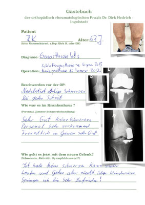 Beidseitige Arthrose in den Knien. Rechts nur innenseitig - deshalb unikondylärer Schlitten ( de Puy Sigma) links schwere Arthrose - Innex Oberflächenersatz Innex Fa. Zimmer