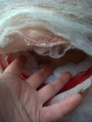 CANCER 2: MASTECTOMY Detail