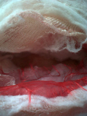 CANCER 2: MASTECTOMY Detail