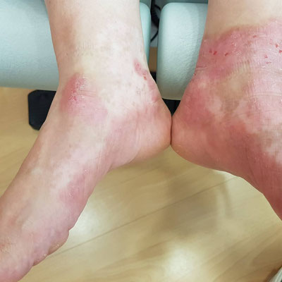 Nach Behandlung mit coldPlasma und Jordan Linie