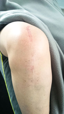 Storfelder Op Narben Twinergy