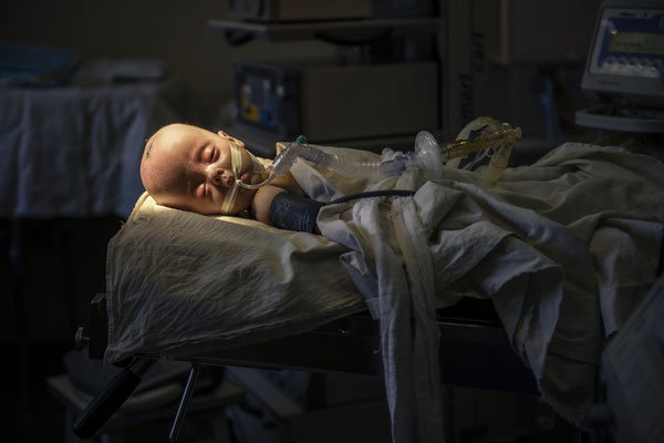 Anna, 6 months, she suffers from hydrocefalus, one of the most common pathologies caused by accumulation of radioactive particles in the foetus. Here before the surgery to reduce the liquor on her brain in the Pediatric Clinic in Kiev.