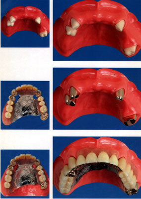 たかす歯科クリニック義歯
