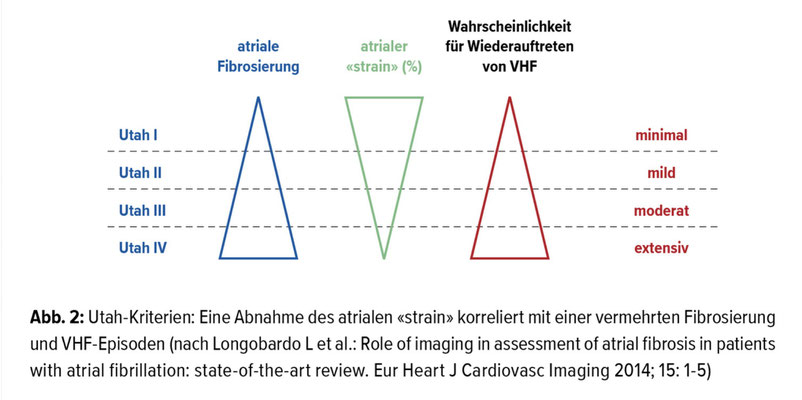 Quelle: UniversimMed,, 12.7.2018, "Kardiales Remodelling bei Vorhofflimmern"