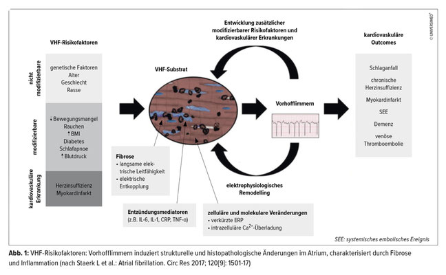 Quelle: UniversimMed,, 12.7.2018, "Kardiales Remodelling bei Vorhofflimmern"