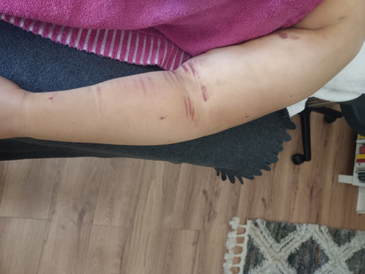 Nachbehandlung Liposuktion bei Lipödem