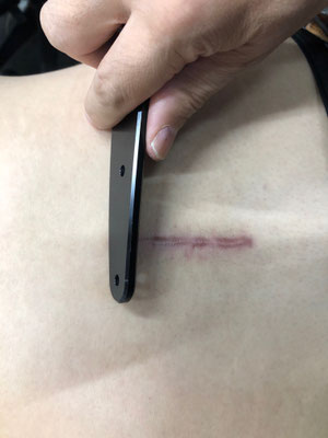 手術痕などの動きの改善に効果が見られました