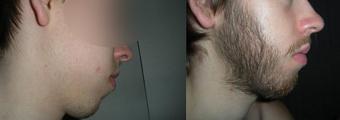 minoxidil barba resultados 1 mes