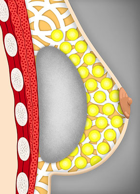 SECTION OF A BREAST (with prosthesis)