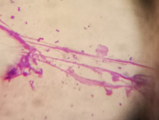 Kokken (runde Bakterien) liegen zwischen den DNA Fäden von Granulozyten