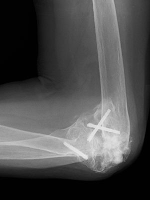 肘関節複合損傷後の難治性偽関節（側面像）　正面像と同様、アライメント不良。