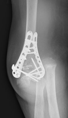 粉砕型・上腕骨遠位端骨折手術後の内固定破綻（正面像）　上腕骨遠位端の粉砕骨片が転位し、肘関節は脱臼している。