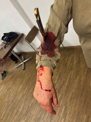 Stichverletzung am Unterarm