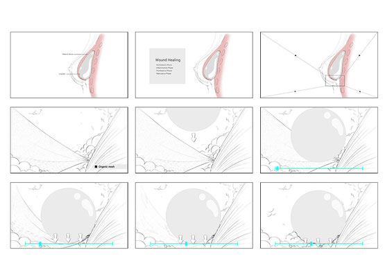 Storyboard about different types of surgical meshes used to promote wound healing in breast implant surgeries. Made in service of Demcon | Nymus3D - page 01
