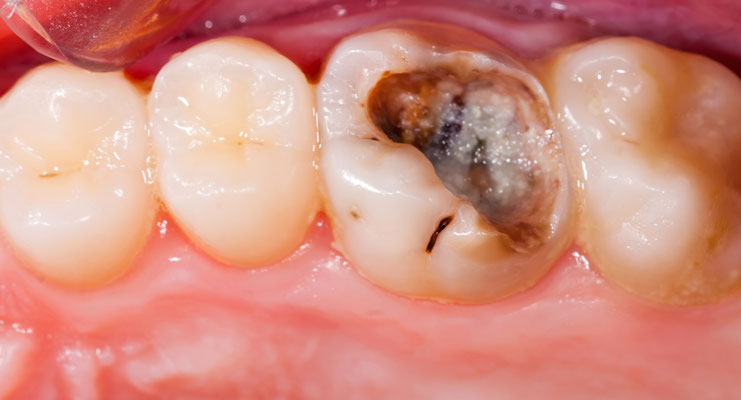 Hochwertiger Zahnersatz Zahnarzt An Der Residenz Dr David Muller