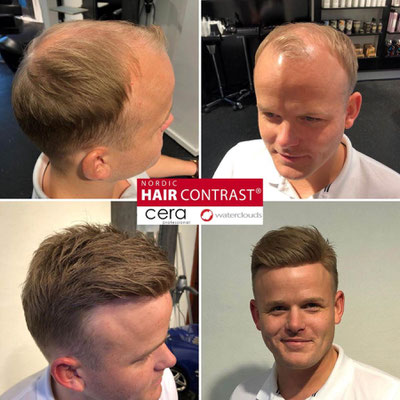 Beispielbild bei einem jungen Mann mit blonden Haaren zum Thema Haarverdichtung by Nordic Hair Contrast