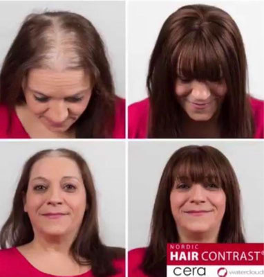 Beispielbild bei einer Frau zum Thema Haarverdichtung by Nordic Hair Contrast