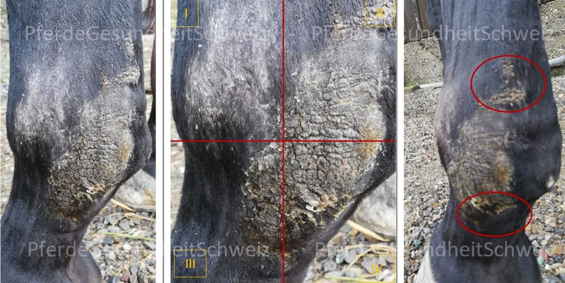 Tag 1 - Behandlungsbeginn: Verruköse Veränderung - Fissuren - Wundexsudat im 3. und 4. Quadrant - Schwellung trotz Ruhebandage - Verklebungen des Gewebes