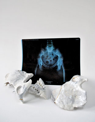 Infertilité, 2017, bassin en porcelaine, feuille d’or, 60x40x8cm. Radiographie du bassin.