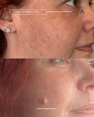 Ergebnis des Phyto Fenol Peelings