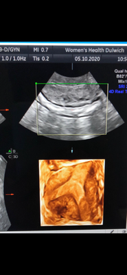 4D image of subseptate uterus