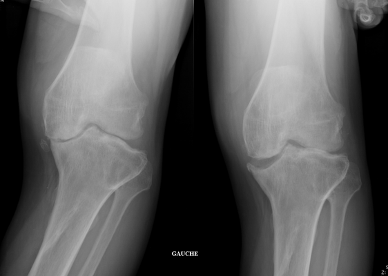 artrosis mas importante de la rodilla : les huesos se atravesan, se deforman.