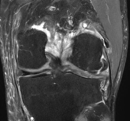 IRM genou arthrose évoluée, Dr Rémi Toulouse