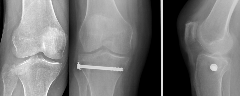 Fractura de meseta tibial Schatzker 2, cirugia deportiva : tornillo percutanea con artroscopia. Rehabilitacion inmediatamente, debe andar con muletas 2,5 meses.