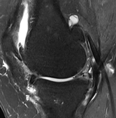 IRM genou arthrose évoluée de profil, Dr Rémi Toulouse