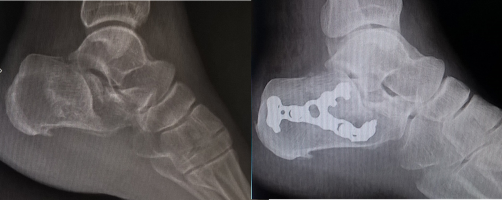 Fractura calcaneum, cirugia deportiva : placa. Rehabilitacion inmediatamente, debe andar con muletas 2,5 meses con bota amovible.