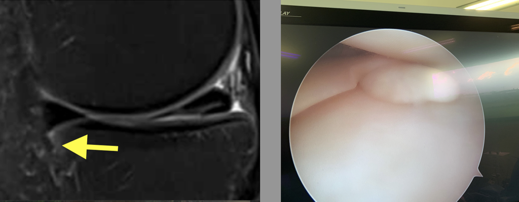 IRM : morceau de ménisque coincé au bord du tibia. Arthroscopie : le morceau est atrappé et retiré