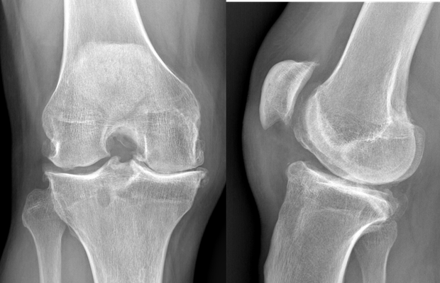 artrosis de la rodilla. Los huesos se tocan porque no queda cartilage.