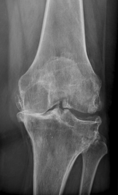 arthrose genou pincement complet, Dr Rémi Toulouse