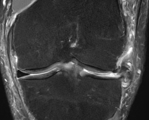 IRM genou arthrose évoluée, Dr Rémi Toulouse