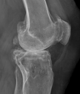 arthrose genou pincement complet, Dr Rémi Toulouse