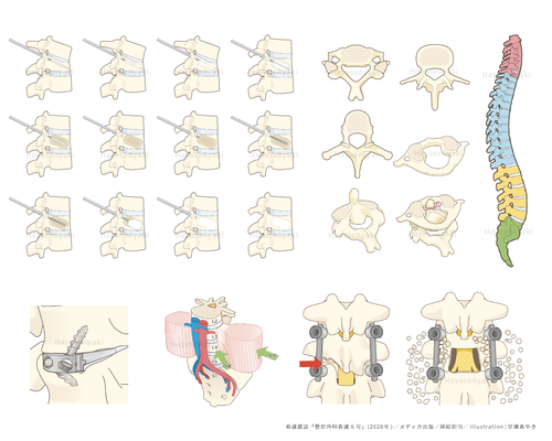 解剖生理　脊椎　脊柱　手術　オペ　術式　整形外科　イラスト　挿絵　看護　医療　雑誌　専門誌