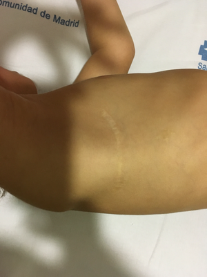 Post-cierre de defecto cardiaco. 3 años post-op