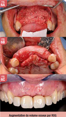 Restauration antérieure implantaire : Le continuum chirurgico
