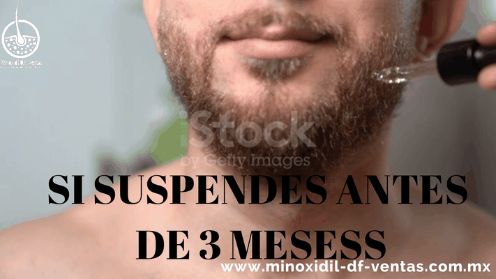 ¿Qué pasa si dejo de aplicar minoxidil ?