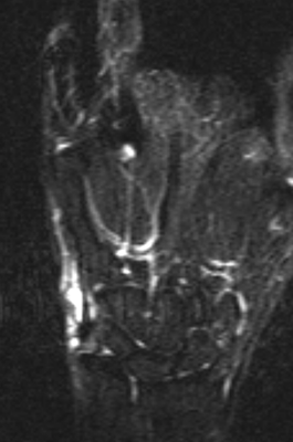 手関節尺側に高輝度信号を認める。  ※ 脂肪抑制T2強調画像