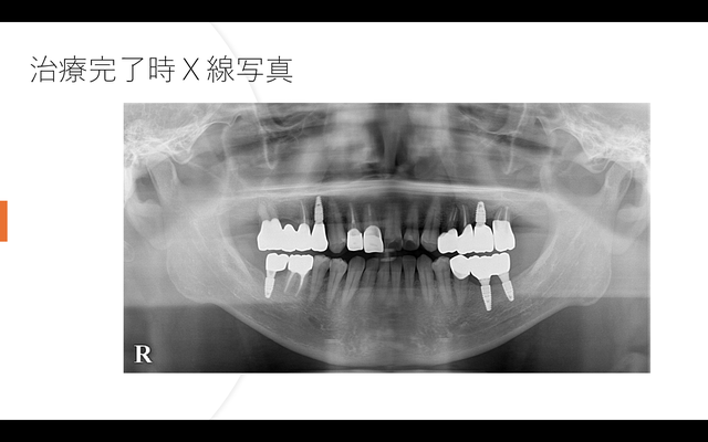 治療完了時X線写真