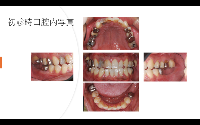 初診時口腔内写真